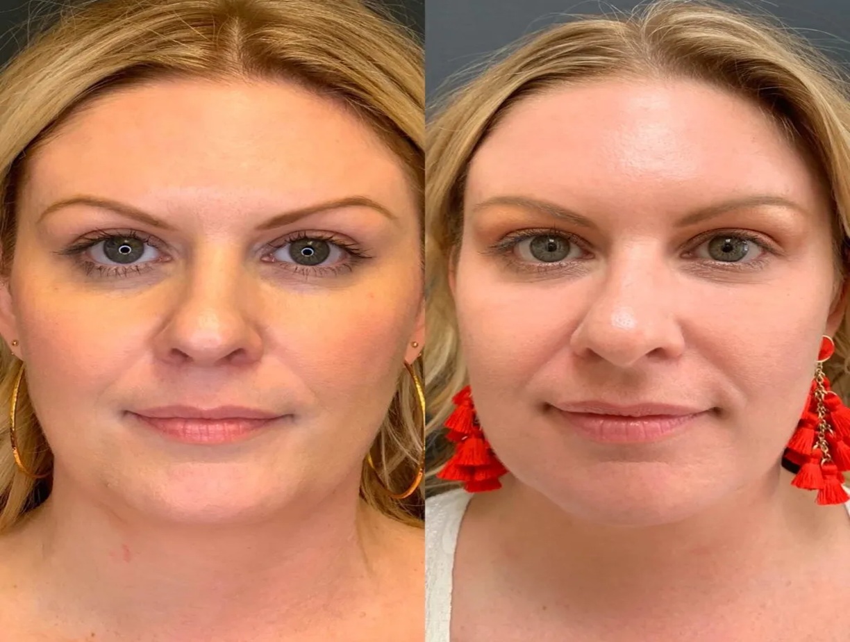 PRP Therapy Altrincham, PRP before and after, Platelet Rich Plasma treatment results UK, Bollin Clinic PRP therapy, natural skin rejuvenation Altrincham