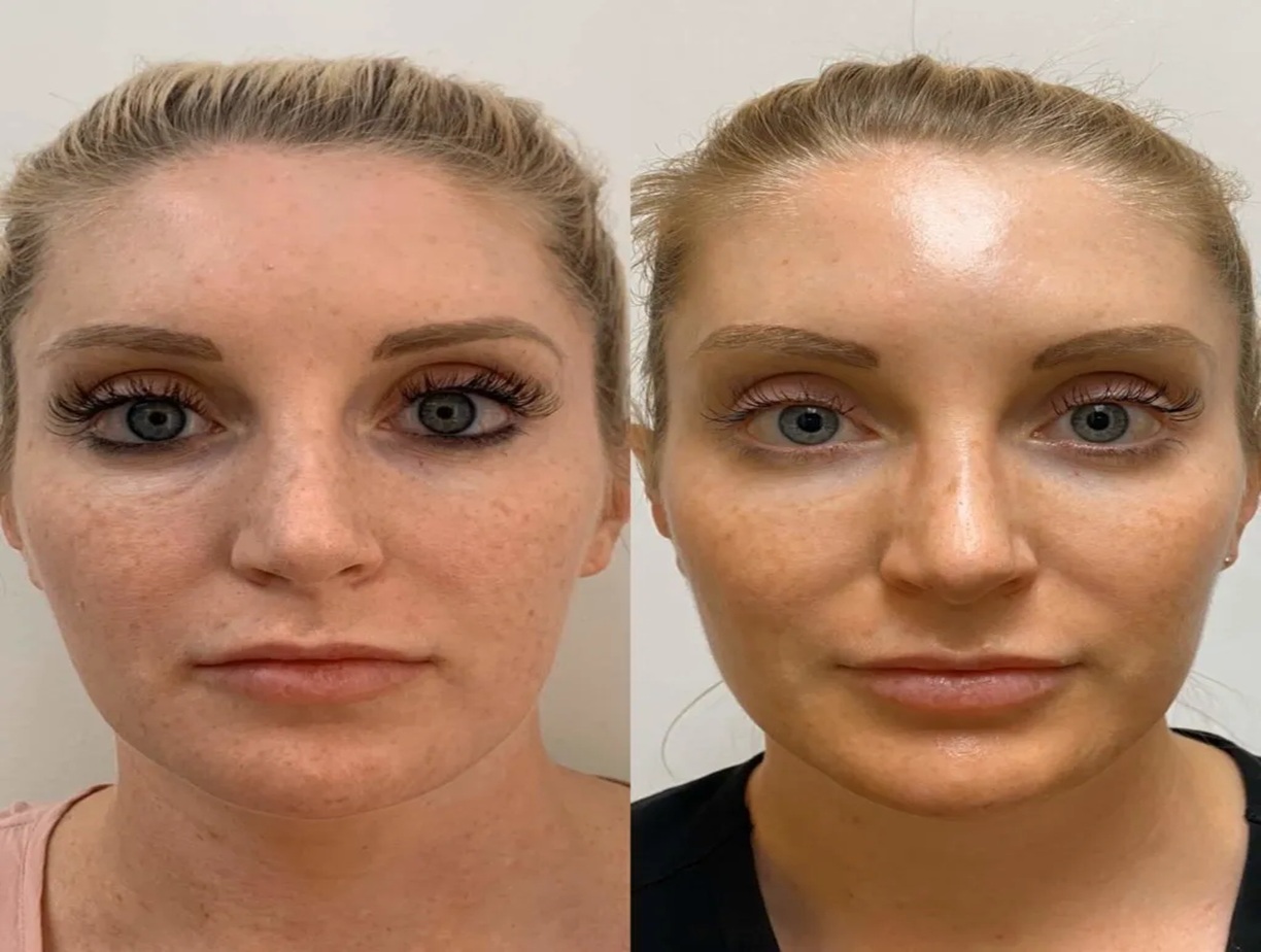 PRP skin results Altrincham, PRP Therapy for face before after, hair restoration PRP UK, Bollin Clinic Altrincham PRP Treatment