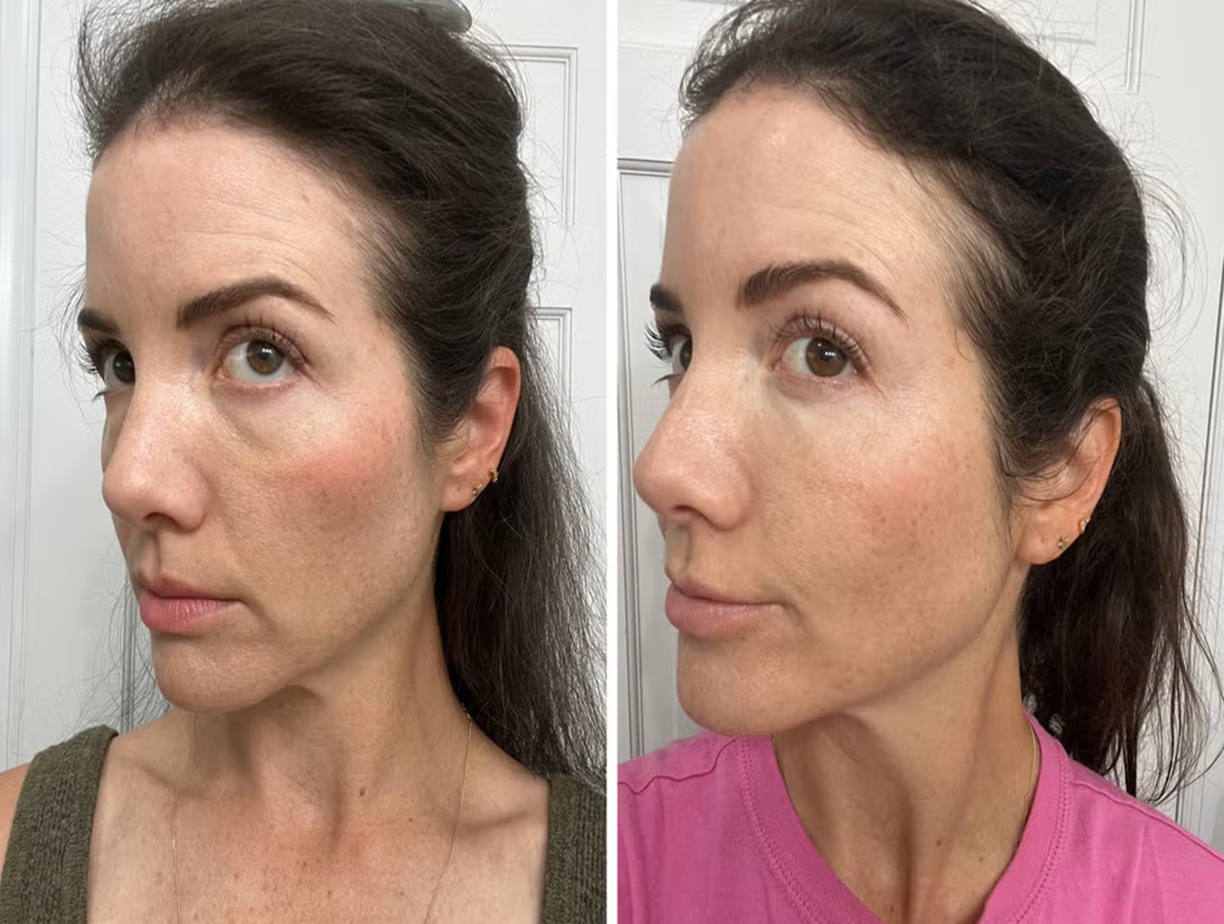 Platelet Rich Plasma PRP before and after UK, Bollin Clinic natural rejuvenation, PRP results for skin texture and tone, Altrincham PRP therapy specialists