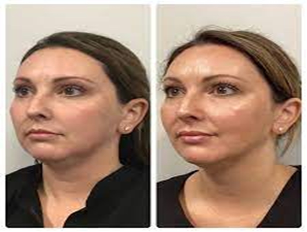 Platelet Rich Plasma PRP before and after UK, Bollin Clinic natural rejuvenation, PRP results for skin texture and tone, Altrincham PRP therapy specialists