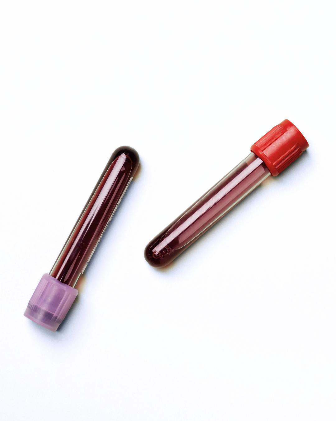 Best PRP Treatment Altrincham - Bollin Clinic