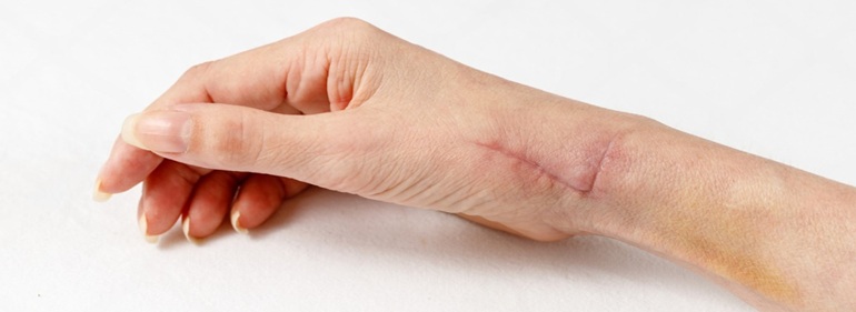 Best Scar Management Treatment in Altrincham, UK