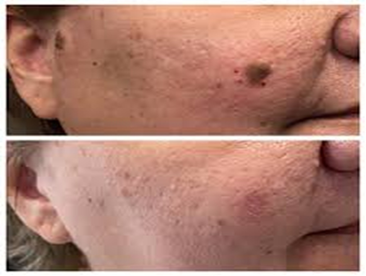 Seborrheic Keratosis example, benign skin growth, dermatology