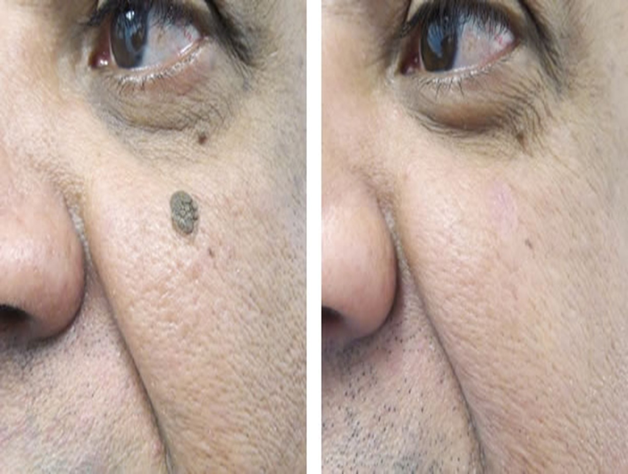 Seborrheic Keratosis example, benign skin growth, dermatology