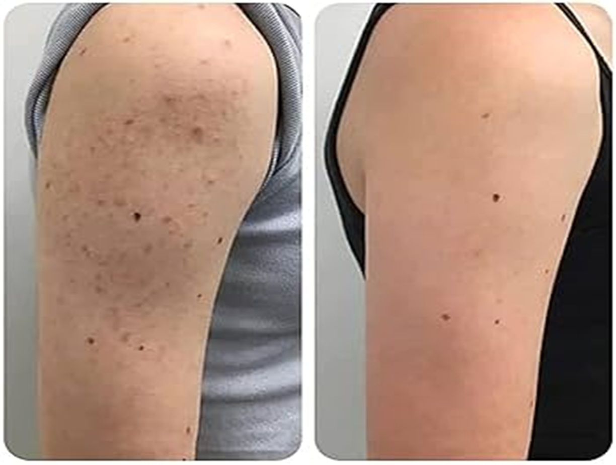 Seborrheic Keratosis example, benign skin growth, dermatology