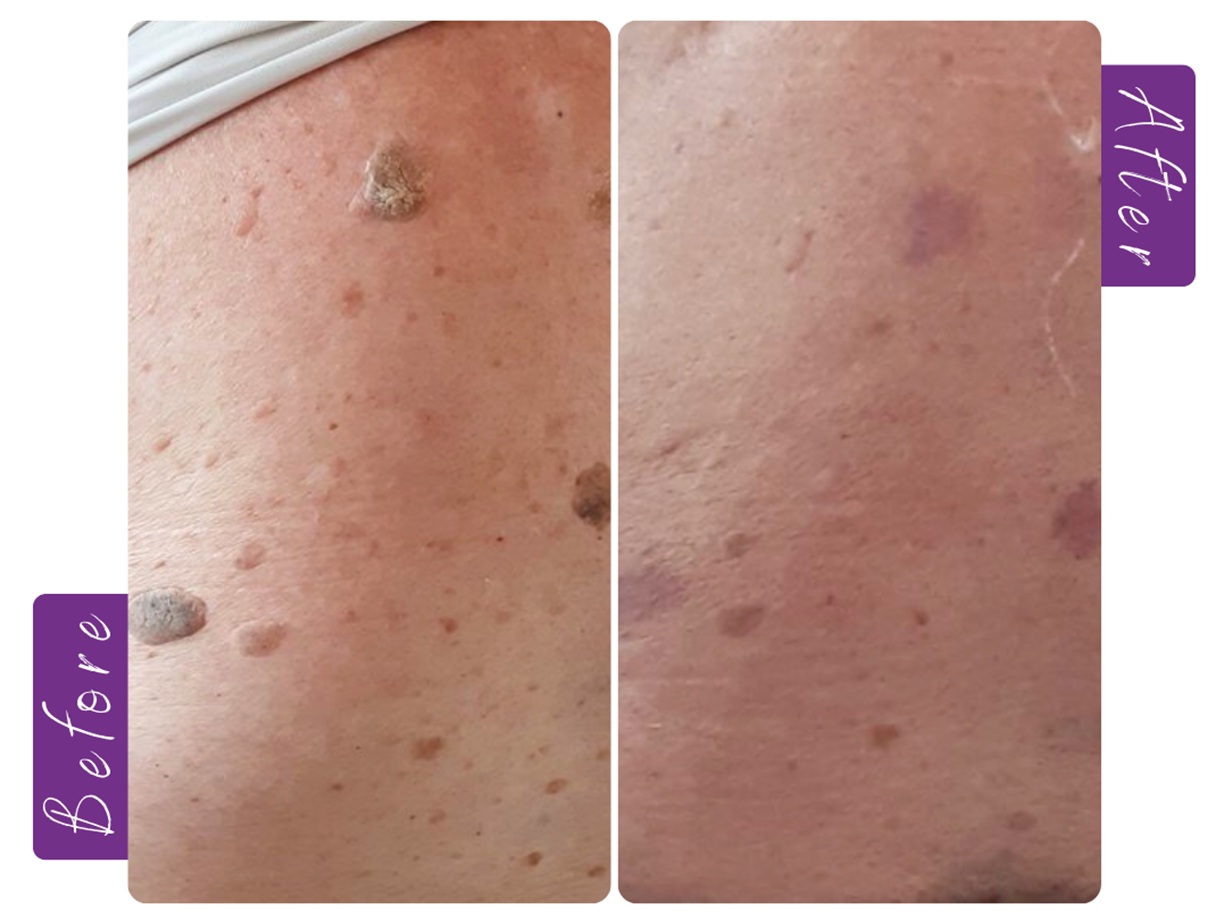 Seborrheic Keratosis example, benign skin growth, dermatology
