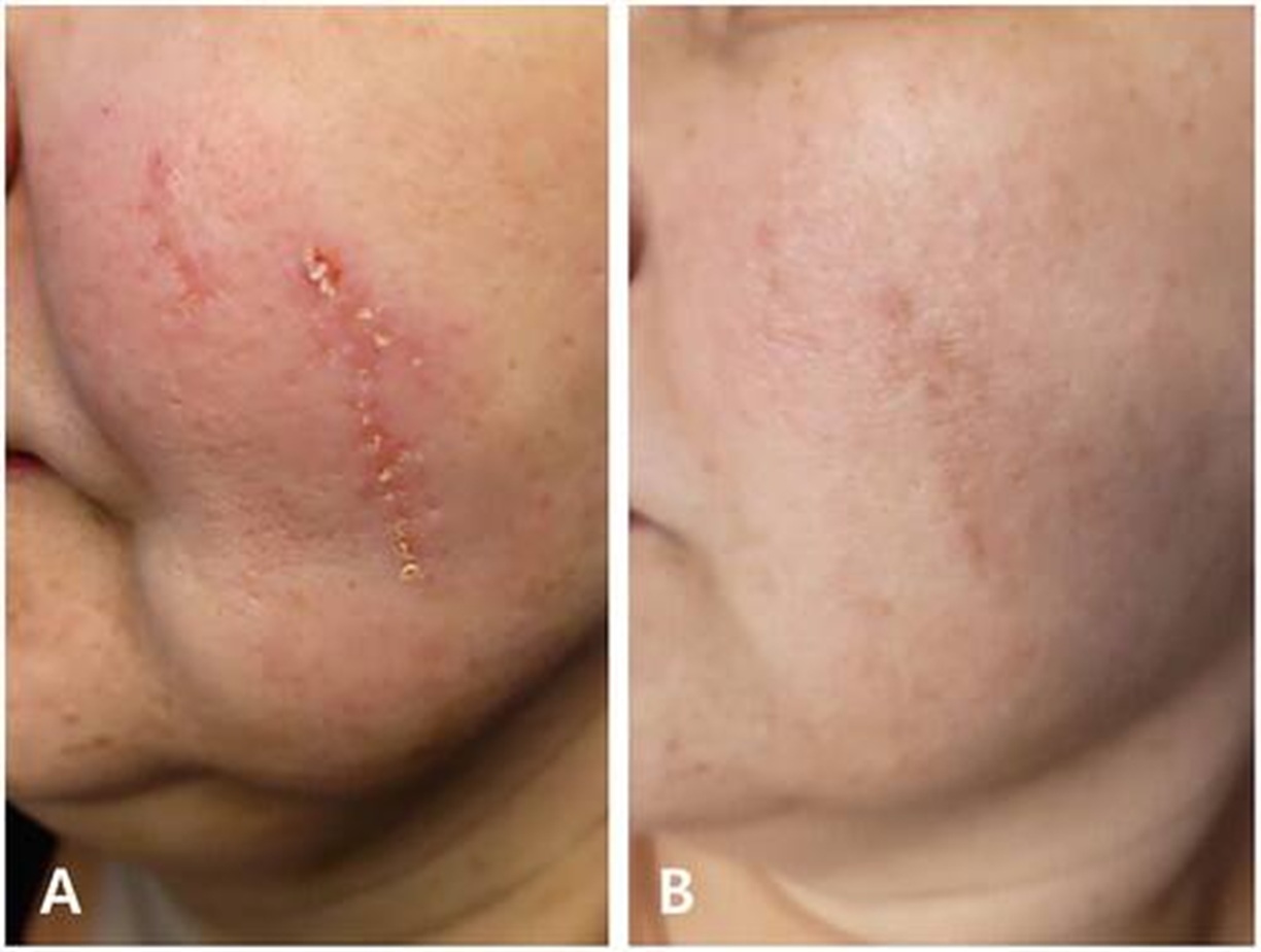 Skin Lesion Removal before Bollin Clinic Altrincham