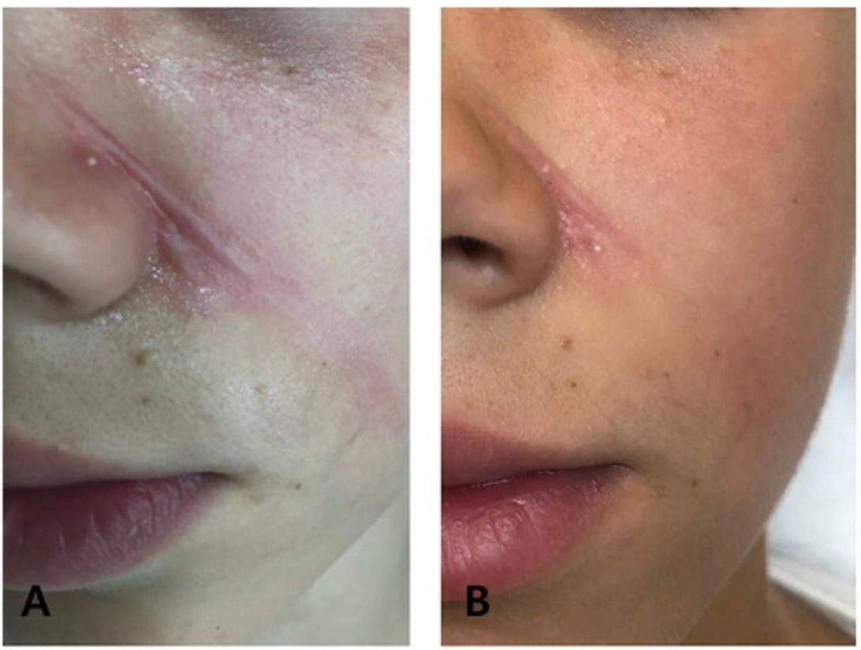 Skin Lesion Removal before Bollin Clinic Altrincham