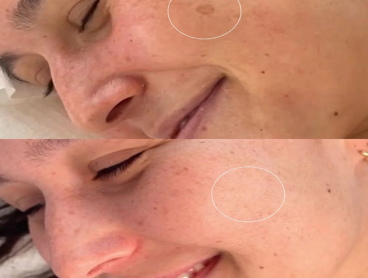 Skin Lesion Removal before Bollin Clinic Altrincham