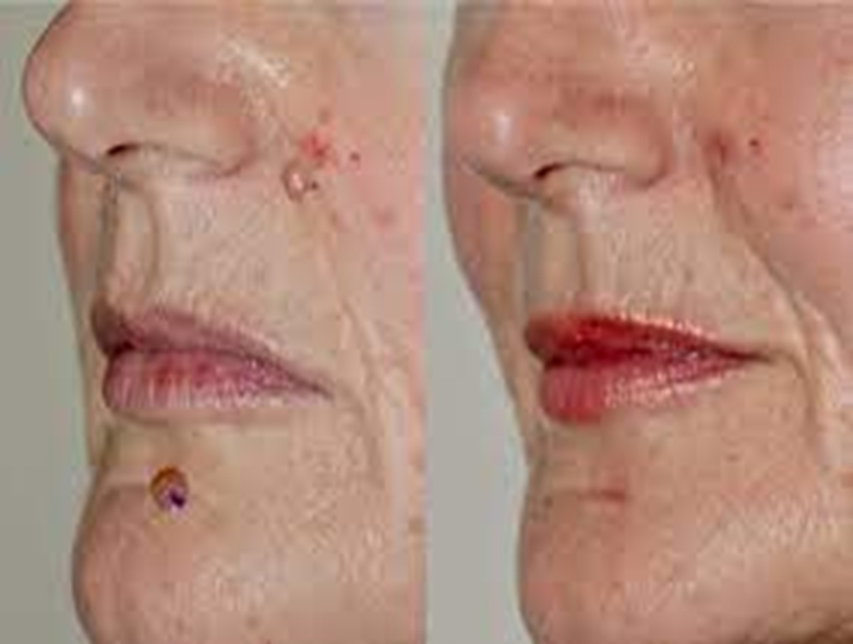 Skin Lesion Removal before Bollin Clinic Altrincham