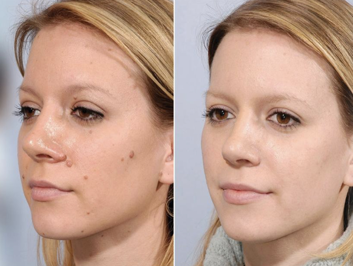 Skin Tag Removal Before and After, Bollin Clinic Skin Tag Treatment