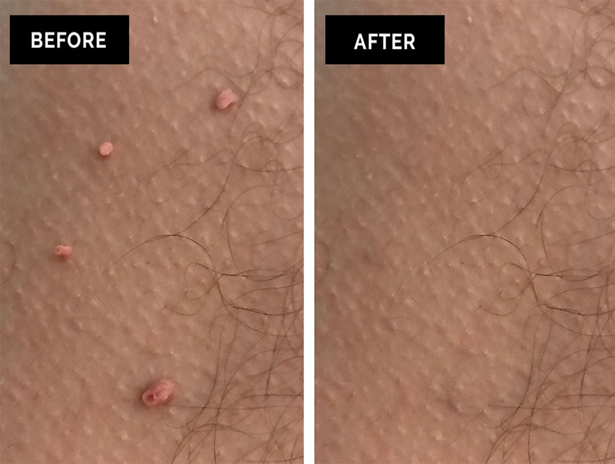 Skin Tag Removal Before and After, Bollin Clinic Skin Tag Treatment