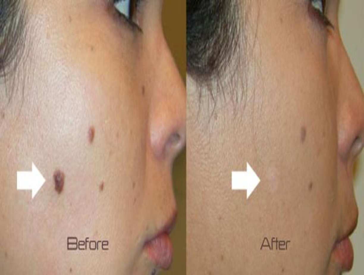 Skin Tag Removal Before and After, Bollin Clinic Skin Tag Treatment