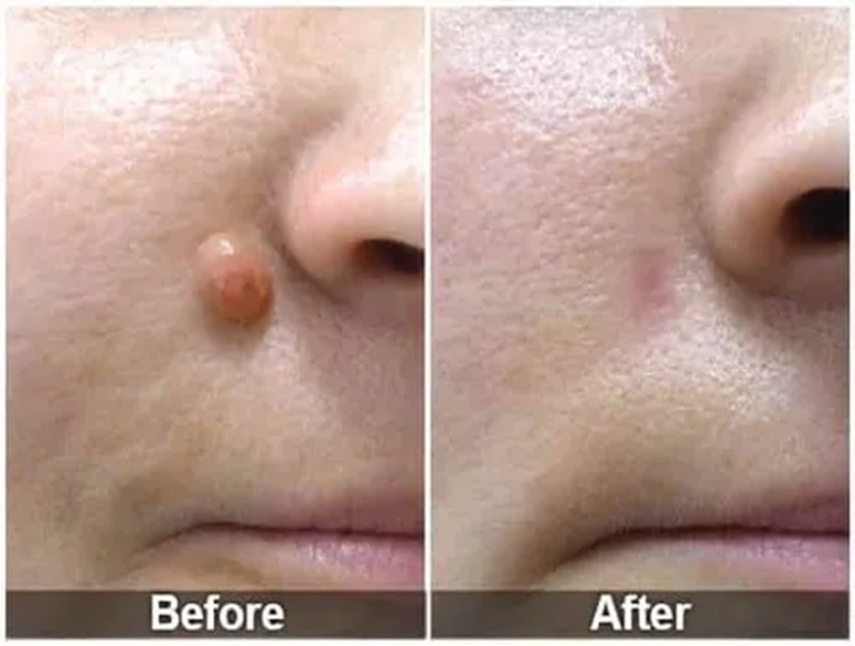 Skin Tag Removal Before and After, Bollin Clinic Skin Tag Treatment