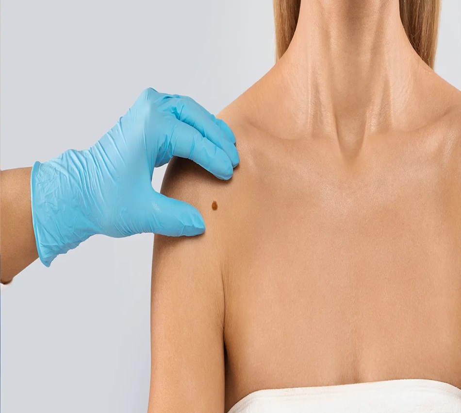 Skin tag removal Altrincham, Bollin Clinic skin treatment, non-invasive skin tag removal, cosmetic skin clinic UK, safe skin tag treatment